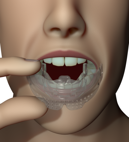 Myobrace For Brackets B1 Ling – Image 4