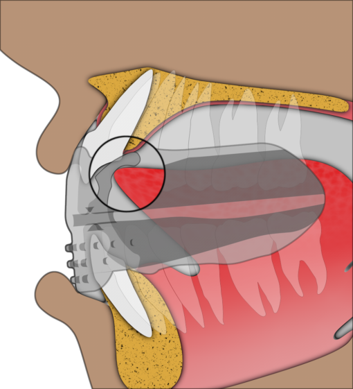 Myobrace For Brackets B1 Ling – Image 6