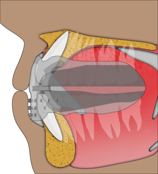 Myobrace For Brackets B1 Ling – Image 5