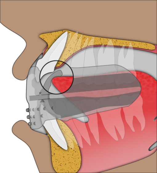 Myobrace For Brackets B1 – Image 5