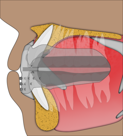 Myobrace For Brackets B1 – Image 6