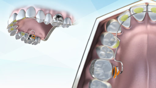The Farrell Bent Wire System™ (BWS) – Image 2