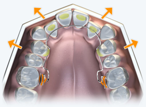 The Farrell Bent Wire System™ (BWS) – Image 5