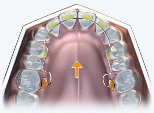 The Farrell Bent Wire System™ (BWS) – Image 8